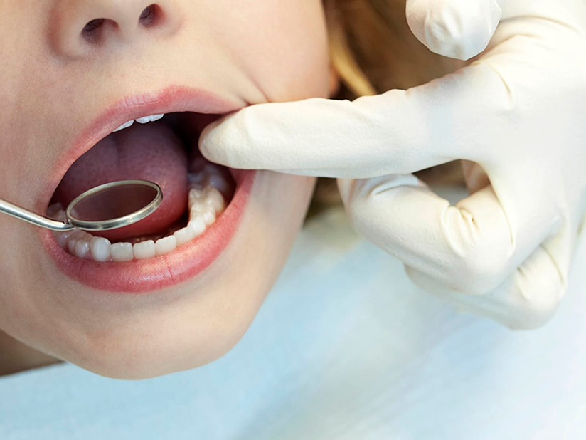 Kids Are Getting Needlessly Exposed to Opioids From Routine Wisdom Tooth Removal